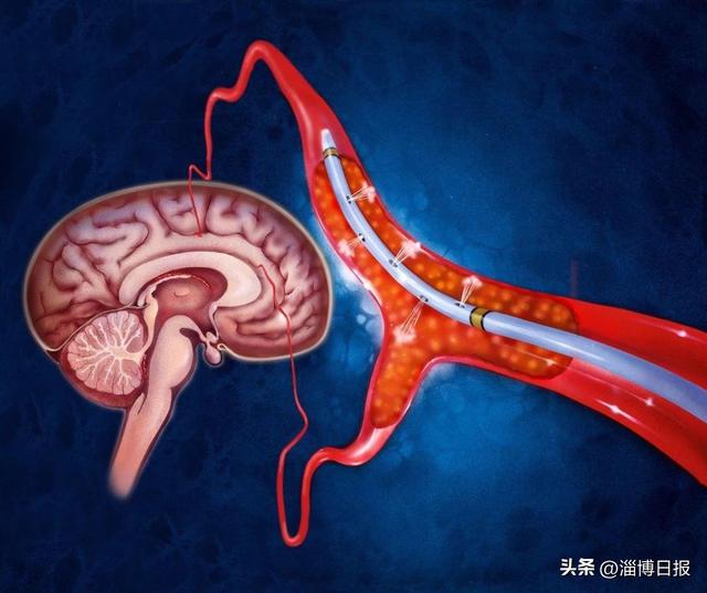 爬楼梯、空腹晨练……这10个锻炼方式不能强身反而伤身！(图3)