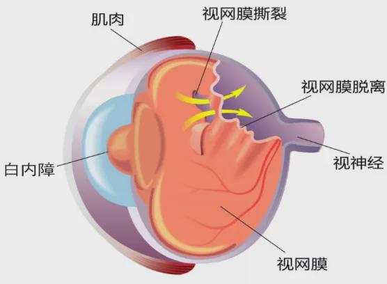 高度近视可致视网膜脱落！如何应对？(图3)