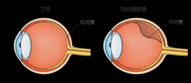 高度近视可致视网膜脱落！如何应对？(图2)