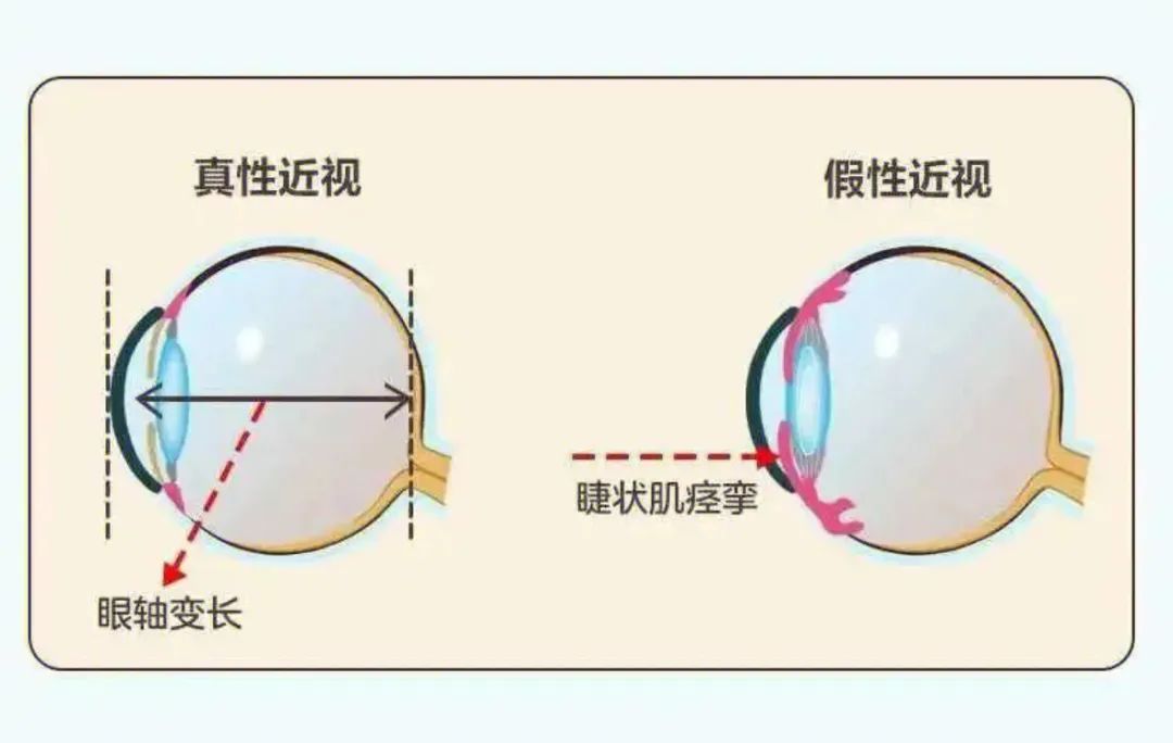 从06到12！郑州8岁娃在郑州爱尔眼科医院的视力逆袭“神话”！(图2)